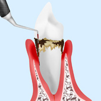歯周ポケット診査