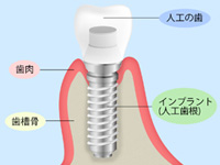 インプラント治療